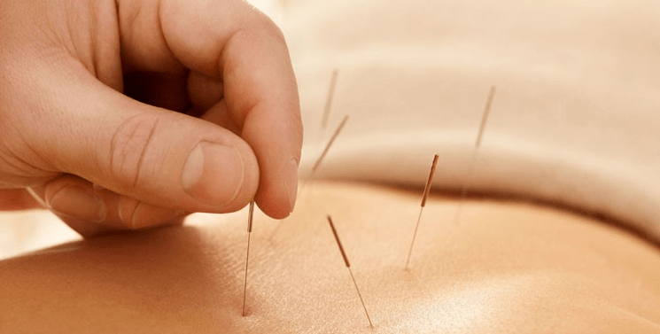 Akupunktur gegen das Rauchen